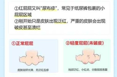 从临床实践到循证研究：新生儿红臀预防策略的系统性探索
