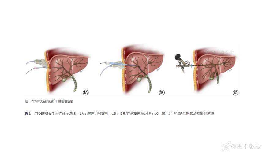 从临床痛点出发:造瘘手术成功率提升的循证实践与论文写作指南